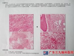 脑科肿瘤爆料案例最新,最新爆料揭示治疗挑战与希望  第3张